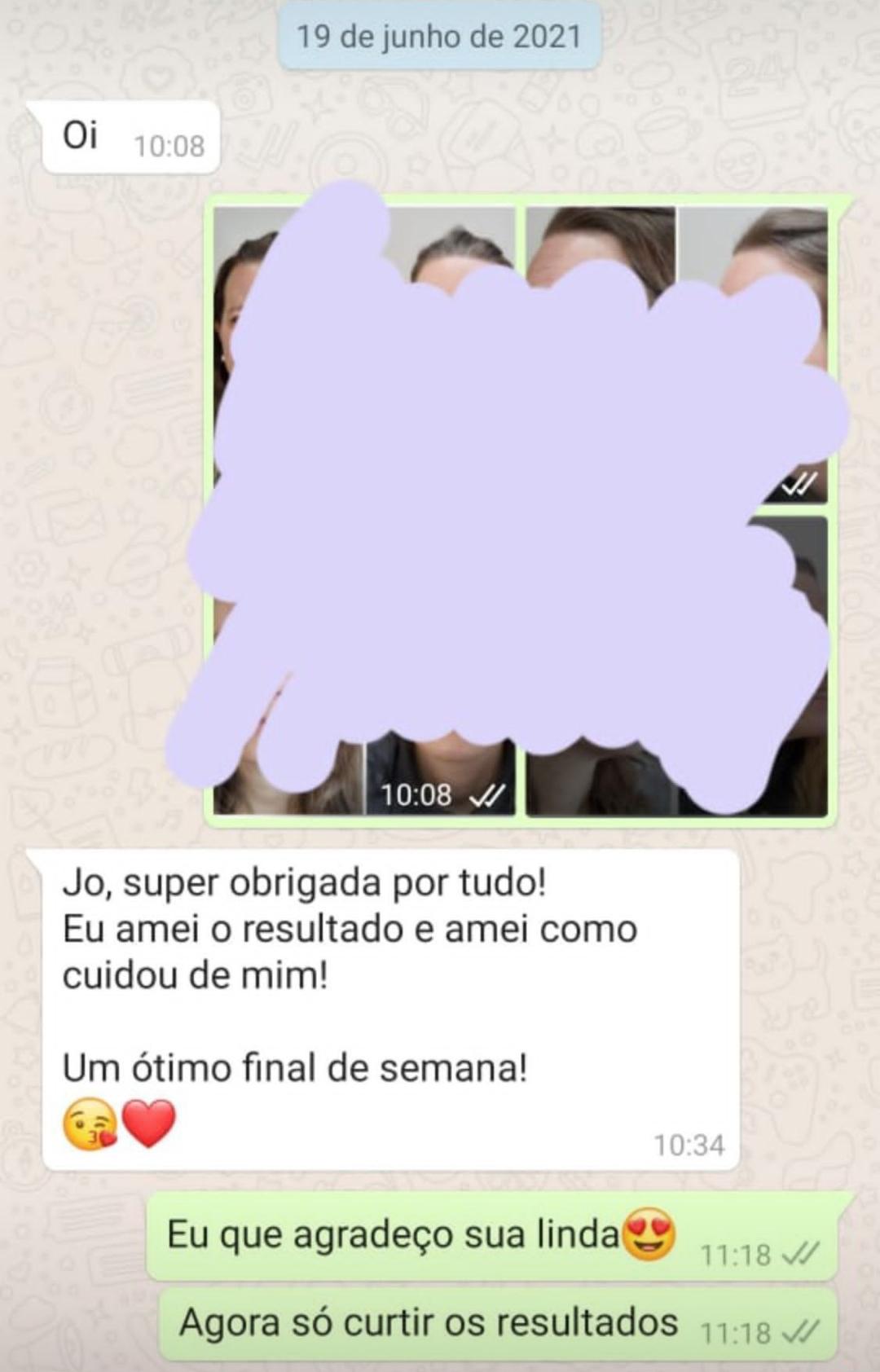 Antes e depois de uma paciente de toxina botulínica